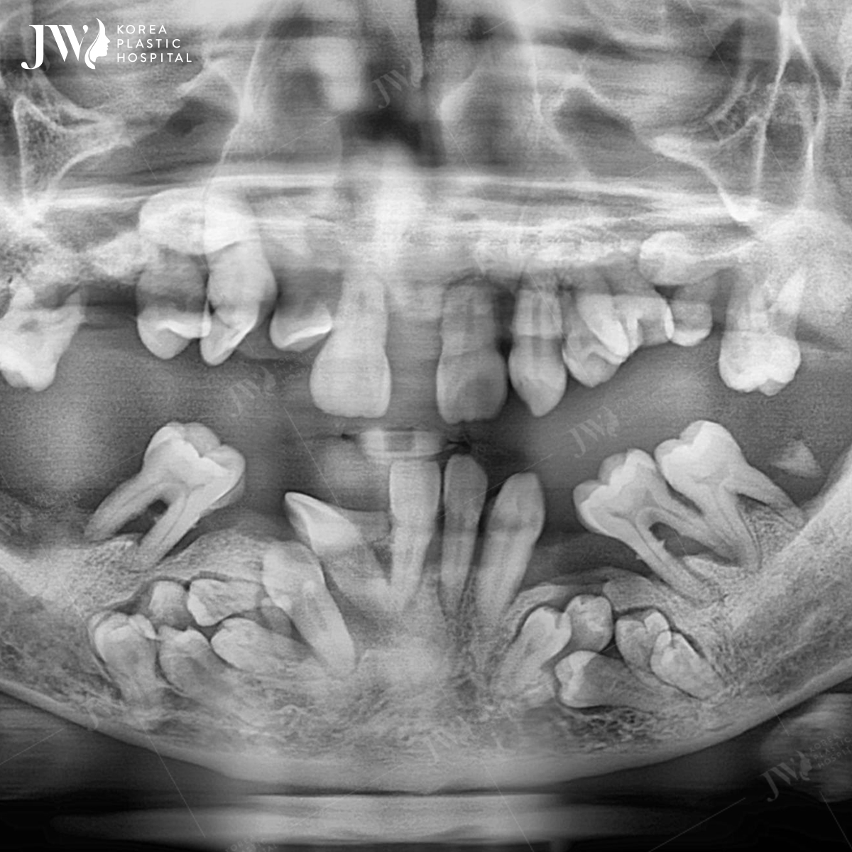 Hình chụp X - quang hàm răng của N.H.V