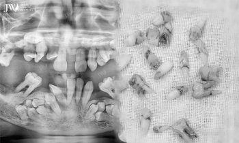 Kinh hoàng bs lấy gần 30 chiếc răng ngầm từ miệng bệnh nhân – U xương hàm mặt