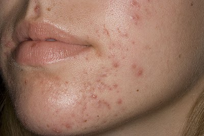 cách trị mụn thịt tại nhà tự nhiên