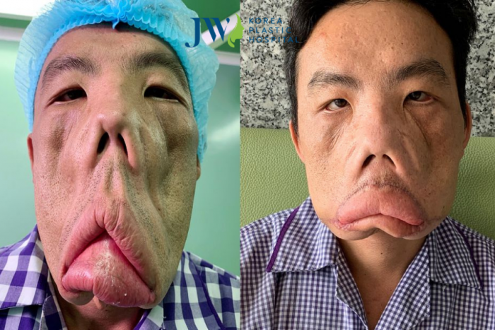 bệnh MRS căn bệnh lạ