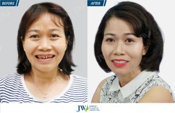 Răng sứ Lisi – Bí quyết tái tạo nụ cười nâng tầm đẳng cấp
