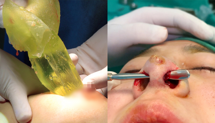 Silicon tràn khắp hố nách bệnh nhân nâng ngực & chiếc mũi bị xuyên thủng sau nâng