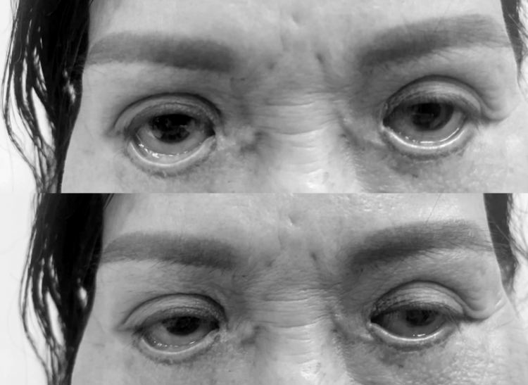 Người phụ nữ với đôi mắt trợn ngược vì cắt mắt ở spa "chui"