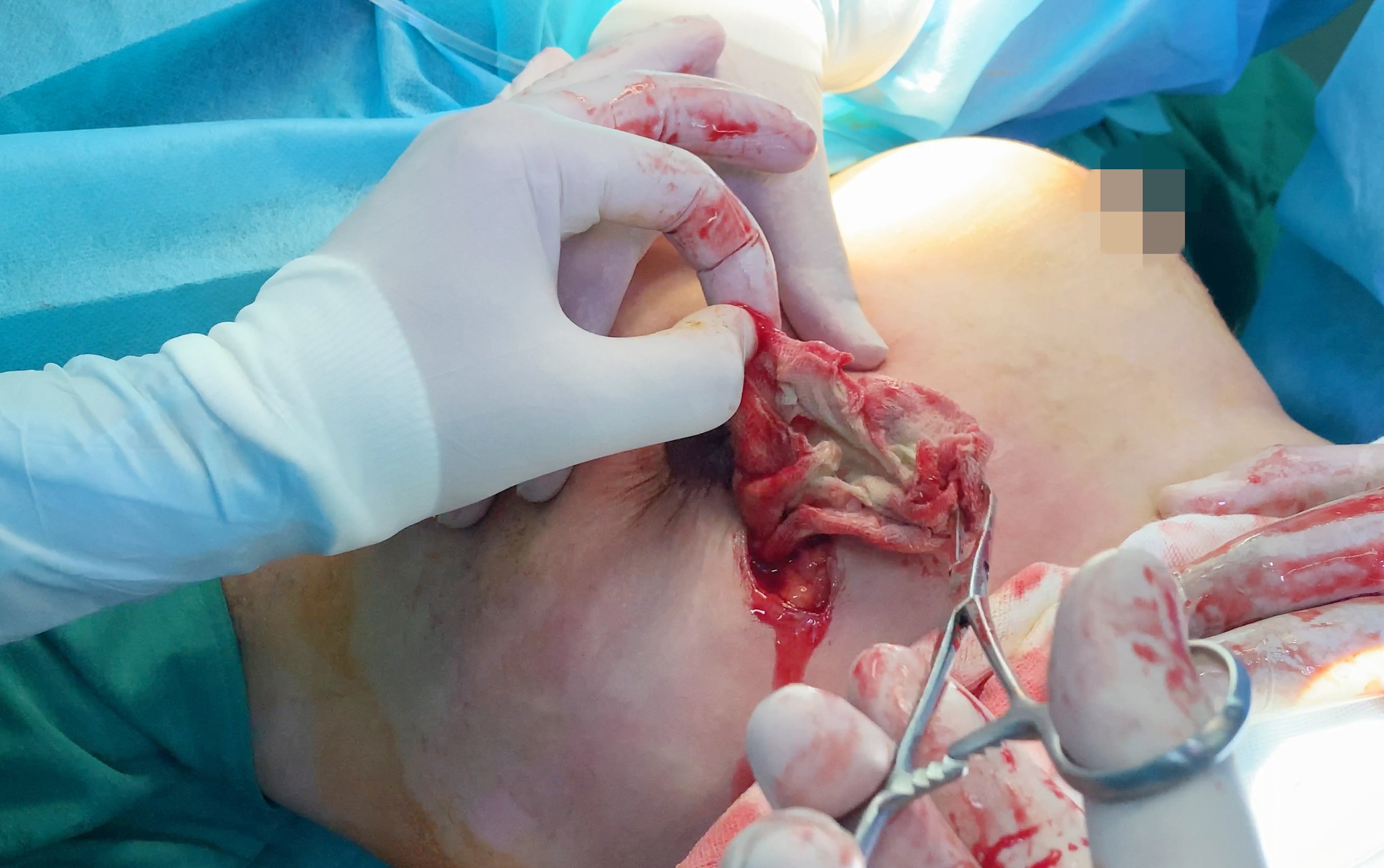 Rút miếng gạc bị bỏ quên trong ngực bệnh nhân qua lổ thủng 5cm2