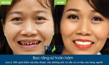 Chỉ vì mắc hạt ổi, người phụ nữ đau đớn mất cả hàm răng vì tin lời nha khoa dỏm bọc răng sứ