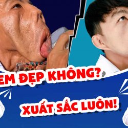 Anh Mến sau 1 năm phẫu thuật thẩm mỹ biến dạng gương mặt giờ ra sao?