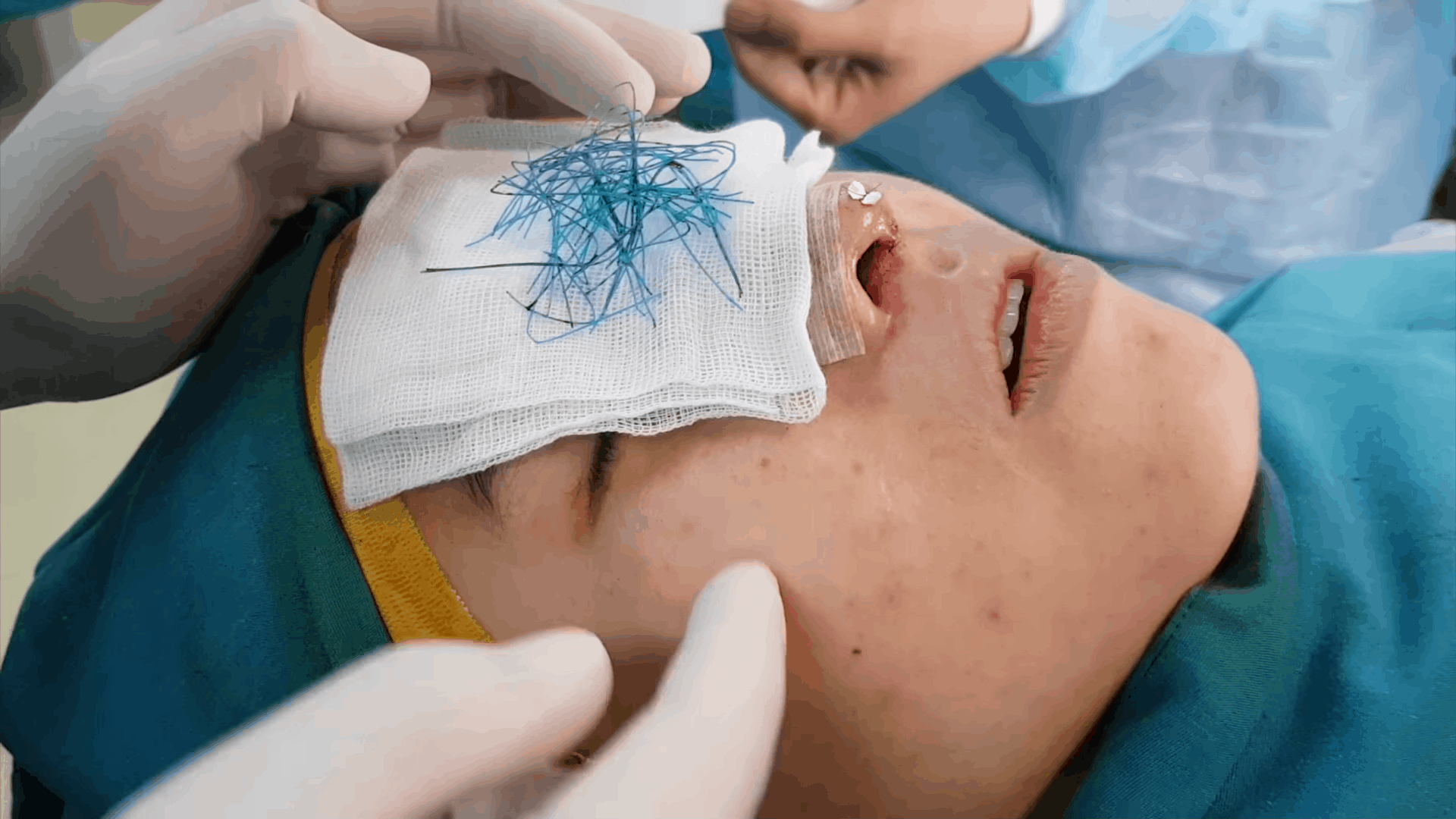 Dr Dung LIVE kỳ 6 biến chứng thẩm mỹ nâng mũi