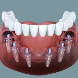 Cắm implant toàn hàm