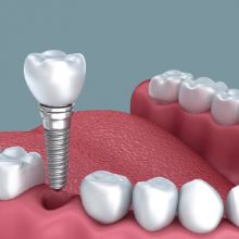 Cấy ghép implant