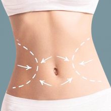 Hút mỡ bụng Laser Lipo