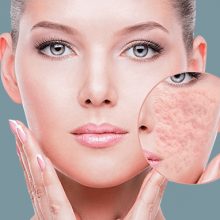 Điều trị Sẹo rỗ