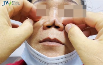 Mũi biến dạng không đầu vì spa kém chất lượng, ngang tàng hoạt động không giấy phép