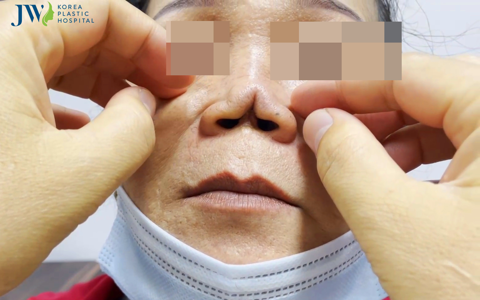 mũi không đầu dị dạng
