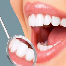 Răng sứ thẩm mỹ