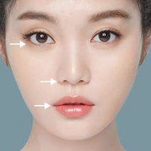 Bảng giá Midface kết hợp căng da mặt bằng chỉ V-Lift bệnh viện JW