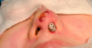 Chín lần mười lượt tin lời “spa chui”, hotgirl 9X hoại tử mũi phải cấp cứu khẩn cấp ngay giữa tâm dịch