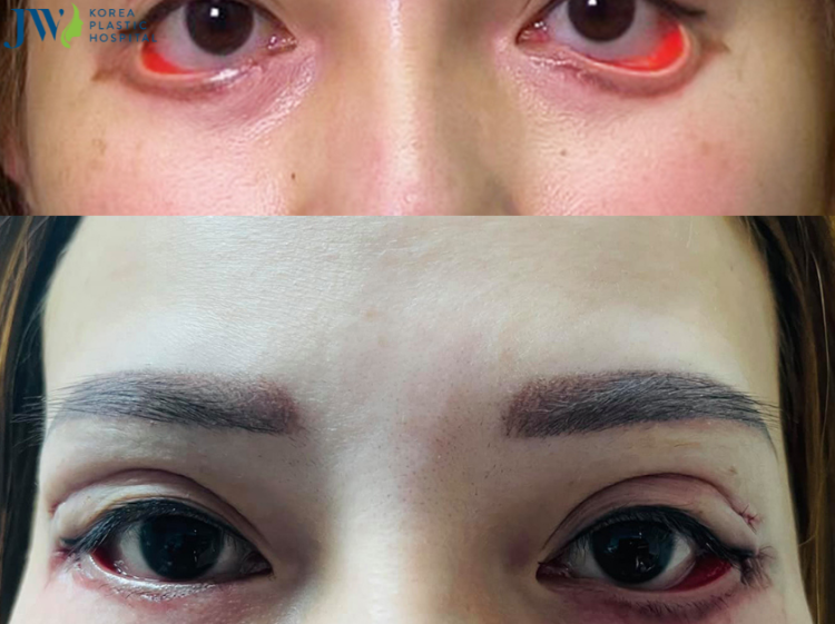 Bác sĩ Tú Dung điều trị cải thiện đến 100% mắt phải, và 90% mắt trái