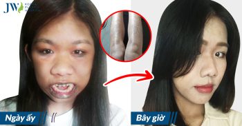 Cuộc sống của cô gái bị gọi là “Khỉ đột” giờ này ra sao?