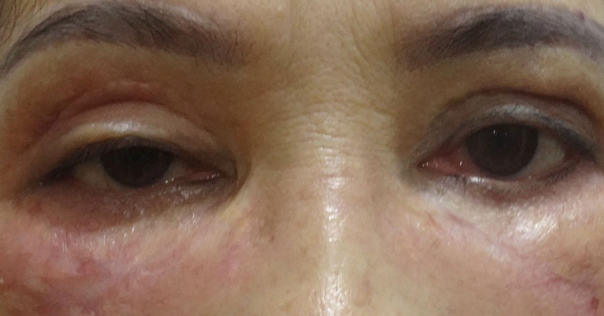 biến chứng thẩm mỹ