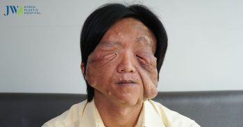 Bi kịch chuyện đời chàng trai nghèo tên Pu bị mắc bệnh u sợi thần kinh