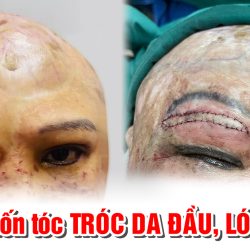 Tai nạn kinh hoàng: Tóc cuốn vào máy nổ đang khởi động, người phụ nữ bị tróc toàn bộ da đầu, 50 năm sống trong đau khổ