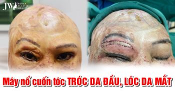 Tai nạn kinh hoàng: Tóc cuốn vào máy nổ đang khởi động, người phụ nữ bị tróc toàn bộ da đầu, 50 năm sống trong đau khổ