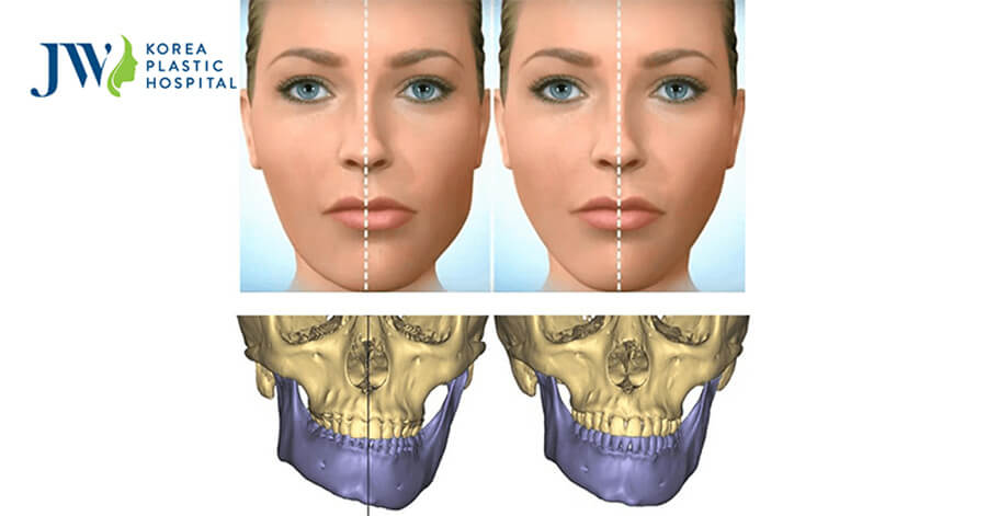 phẫu thuật chỉnh mặt lệch do móm