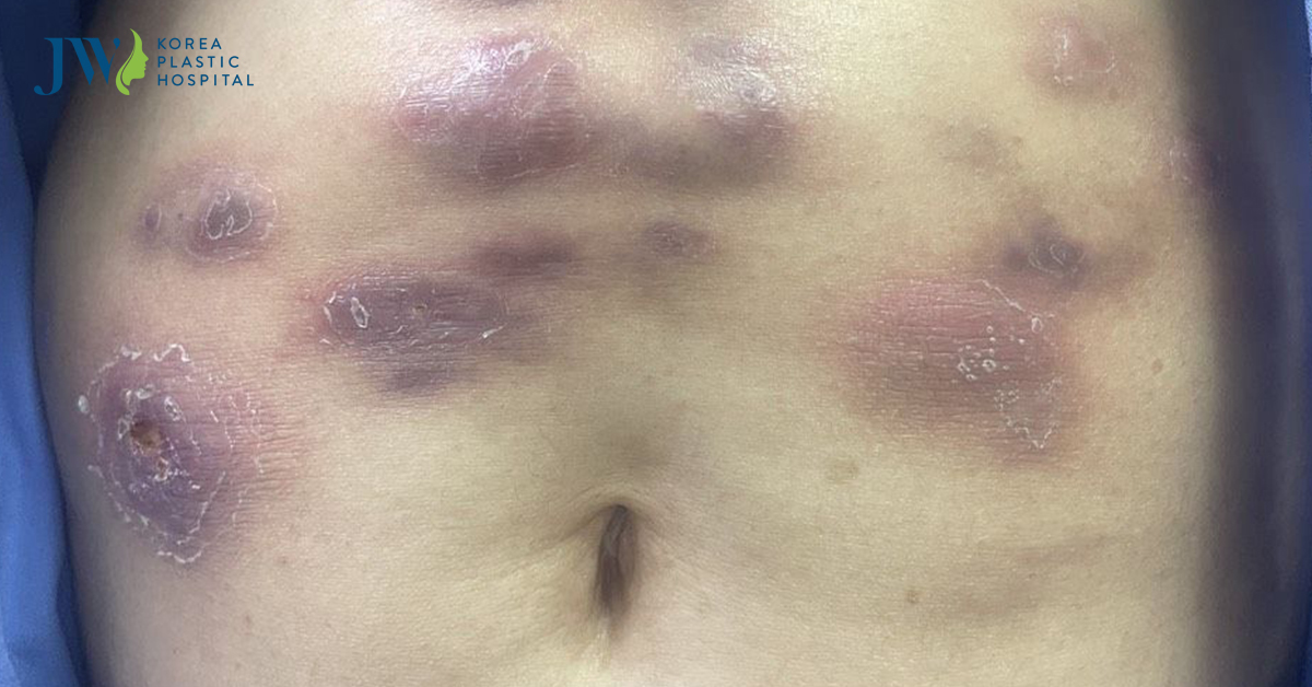 tiem tan mo hoai tu bung