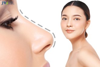 Nâng mũi S Line xu hướng thẩm mỹ mới nhất hiện nay