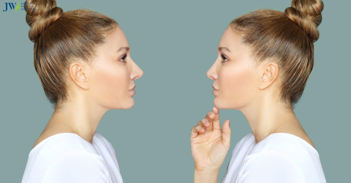 Mũi có thể cao lên trong 1 tuần không Thumb