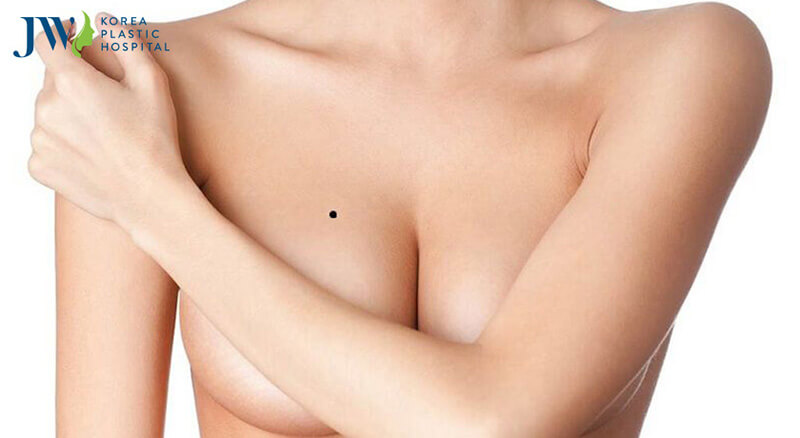 nốt ruồi ở vùng ngực phụ nữ