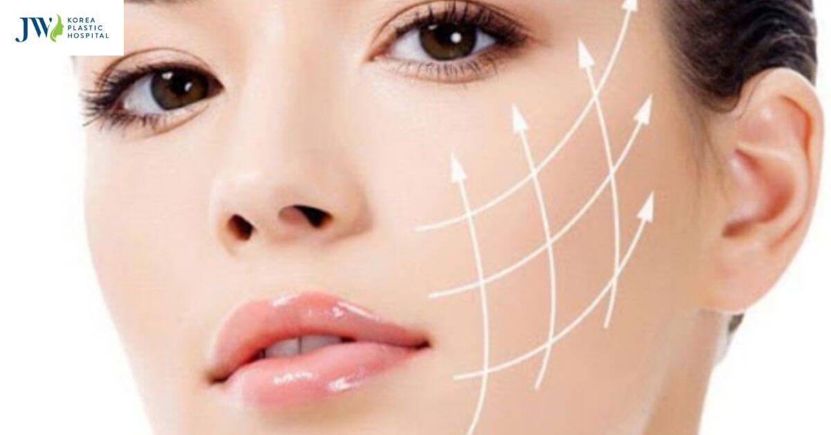 Căng da mặt bằng chỉ collagen