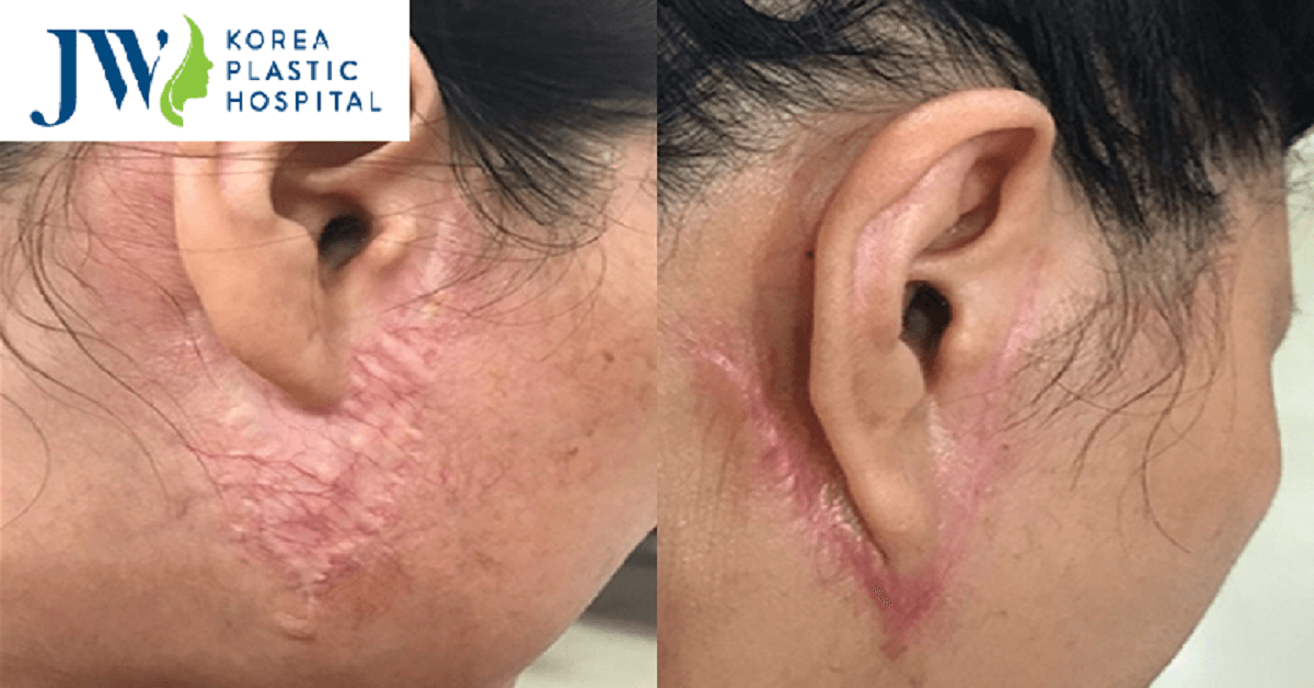 cang da mat bang chi khong tieu 4