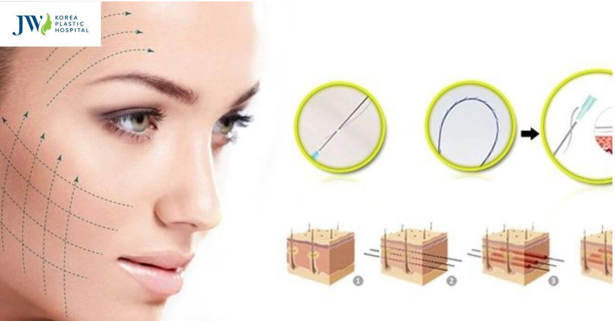 Cấy chỉ collagen