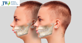 Quy trình & giá phẫu thuật chỉnh hàm hô – Mang lại nụ cười tự tin