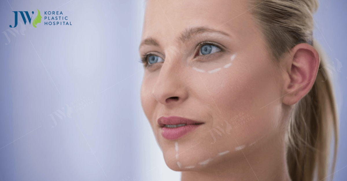 sau khi căng chỉ collagen