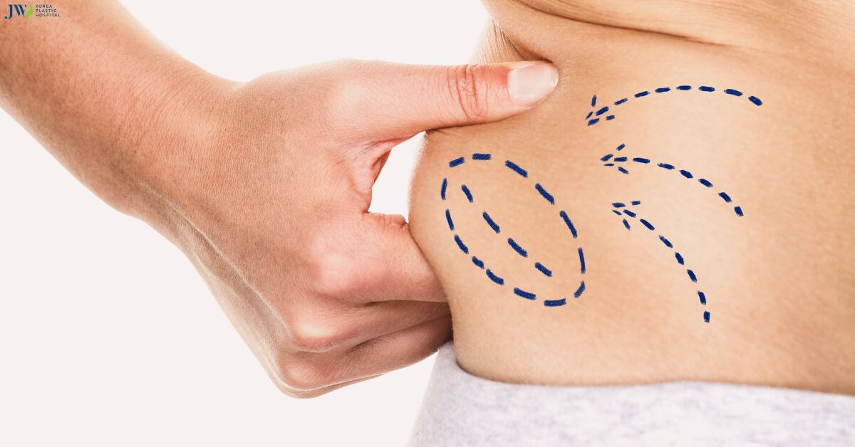 Quy trình chăm sóc bệnh nhân hút mỡ thumb