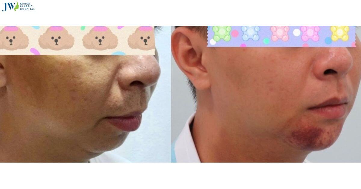 Quy trình chăm sóc bệnh nhân sau phẫu thuật chỉnh hình tiền đình xương hàm (ASO) thumb