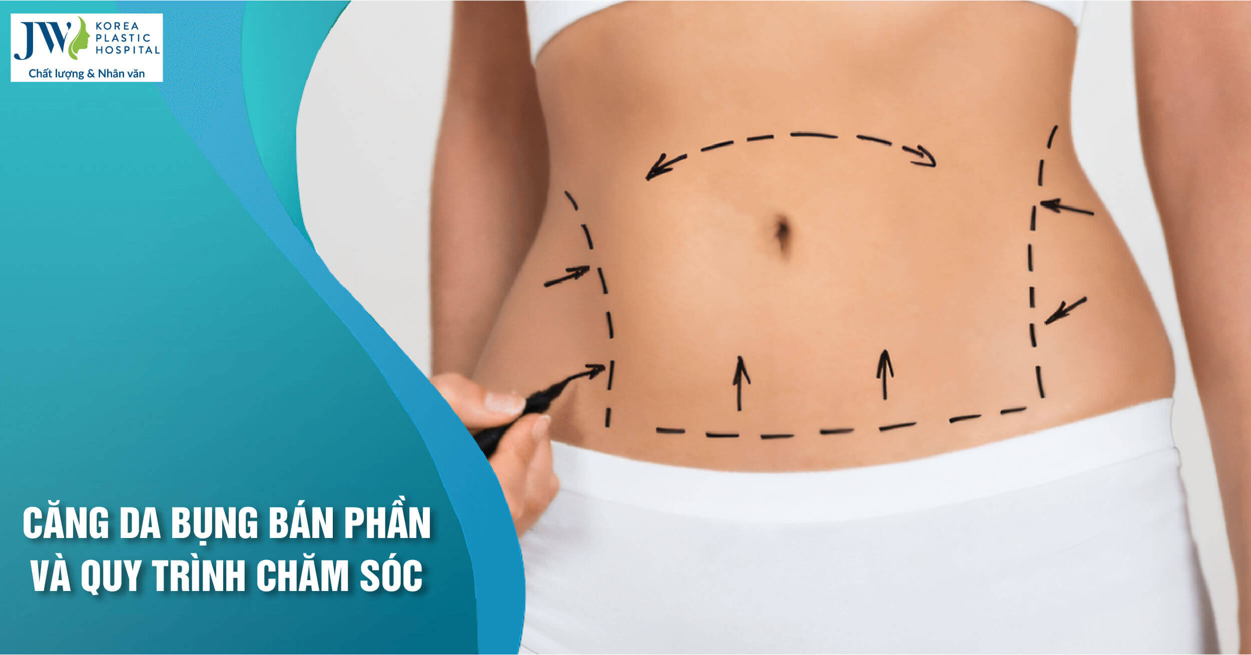 căng da bụng bán phần