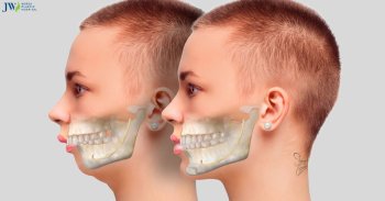 Bạn hiểu gì về hô xương ổ răng? Cách điều trị như thế nào?