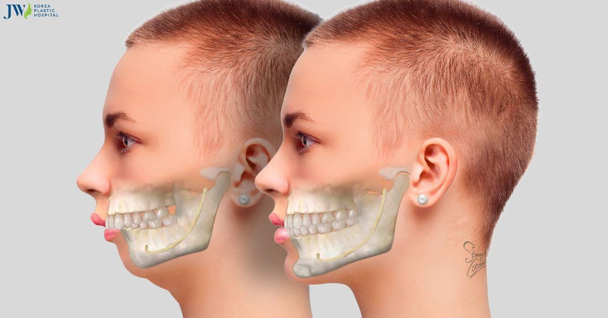 Bạn hiểu gì về hô xương ổ răng? thumb