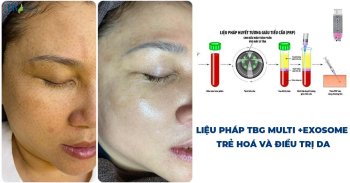 Multi+ Exosome: Liệu pháp và trẻ hóa làn da độc quyền tại JW