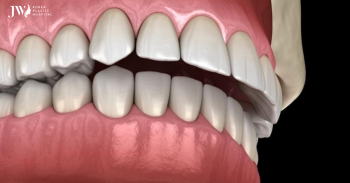 Quy trình niềng răng khớp cắn sâu