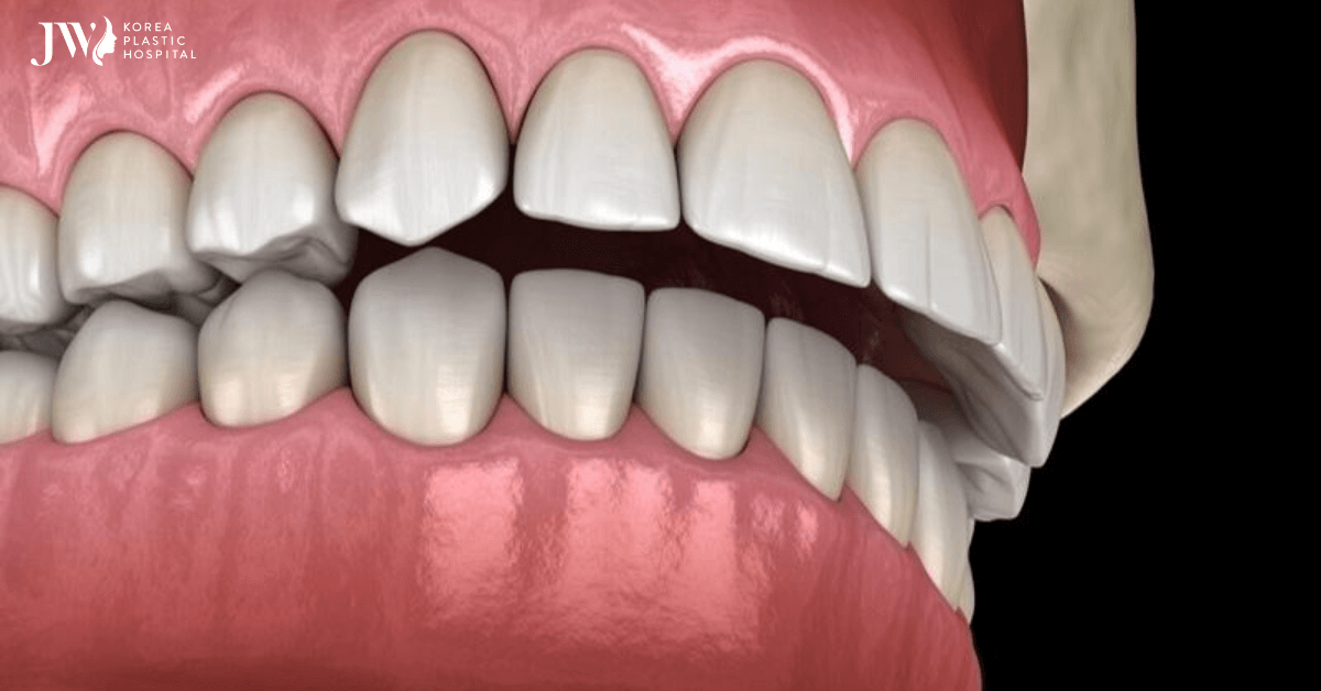 niềng răng khớp cắn sâu