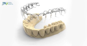 Niềng răng trong suốt AI dành cho trẻ em phụ huynh nên lưu ý