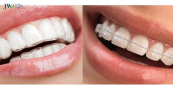 Niềng răng trong suốt AI: Có ăn được không?