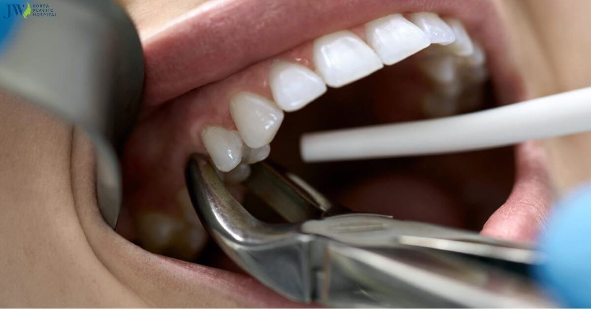 Niềng răng trong suốt AI có cần nhổ răng không? thumb