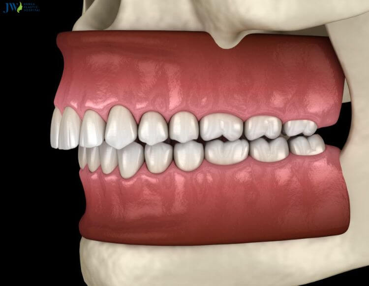 Răng hô hàm trên có niềng răng trong suốt AI được không? 1
