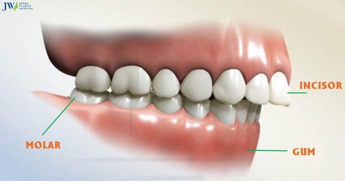 Răng hô hàm trên có niềng răng trong suốt AI được không? thumb