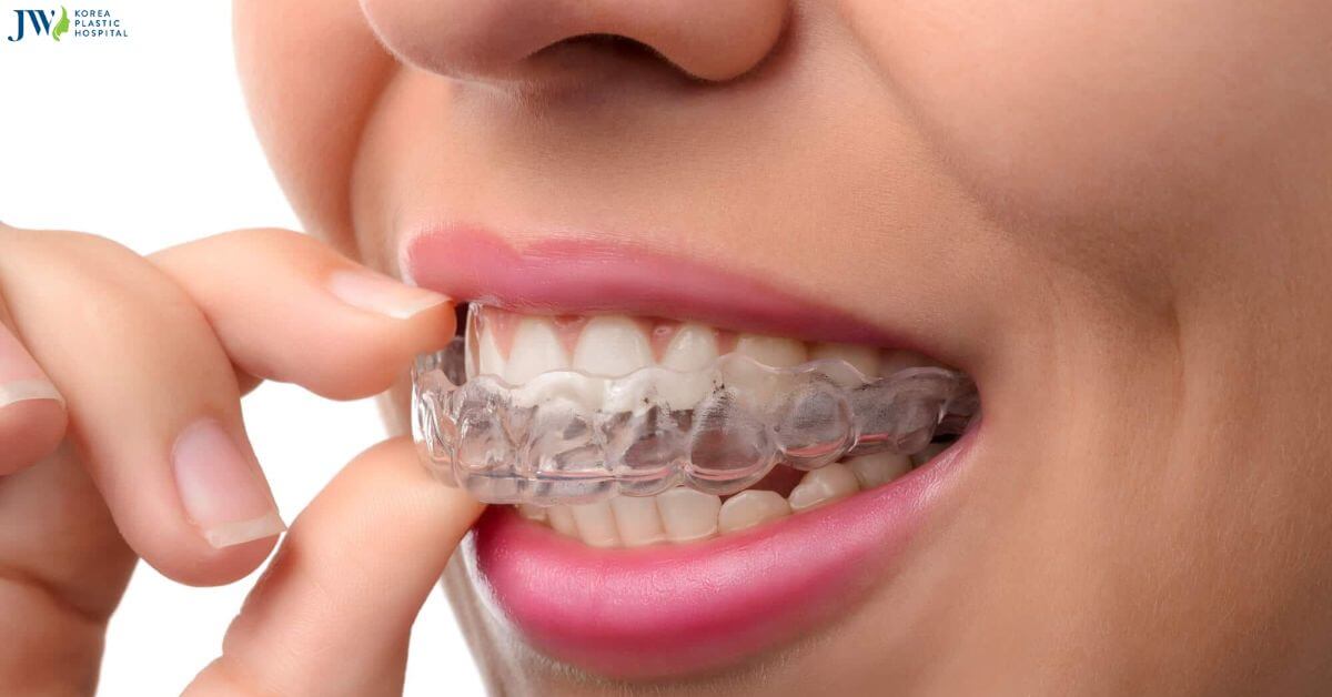 Thế nào là niềng răng trong suốt AI? thumb